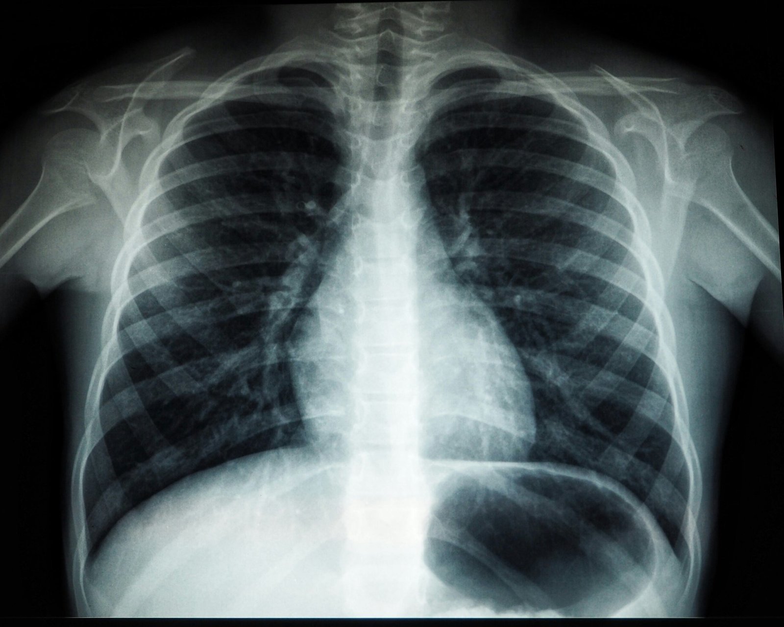 Pulmonary Fibrosis Explained: Early Signs, Causes, and Living Well in Pakistan